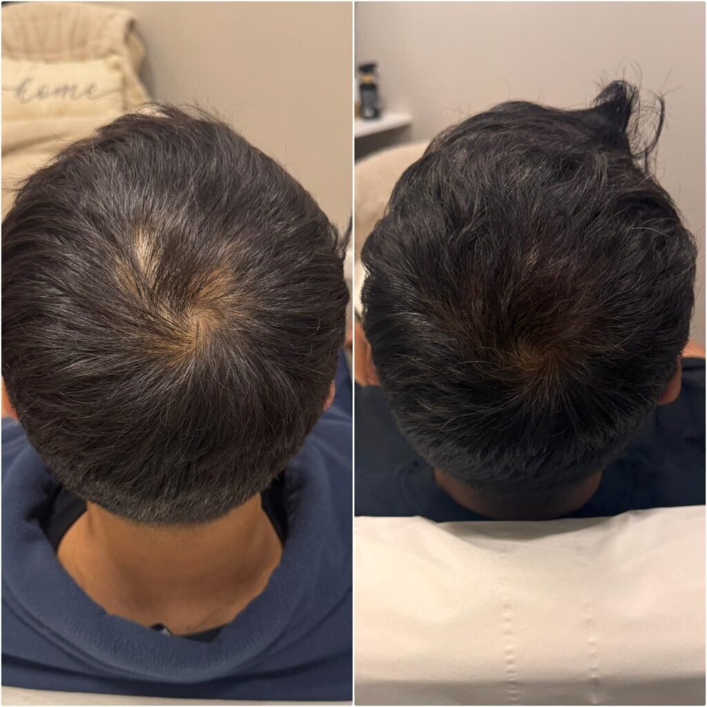 PRP treatment in Pinner
