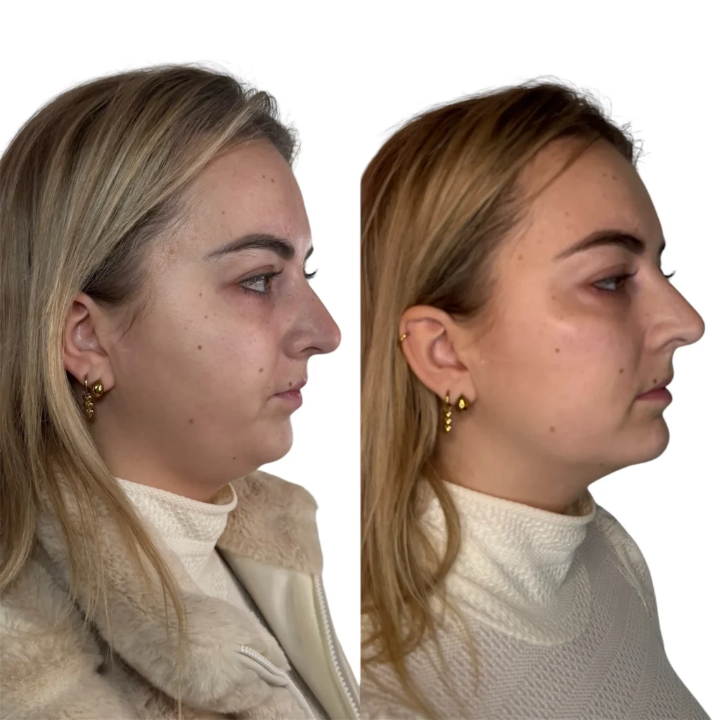 Cheek and chin dermal filler results at Medcura Clinic Harrow