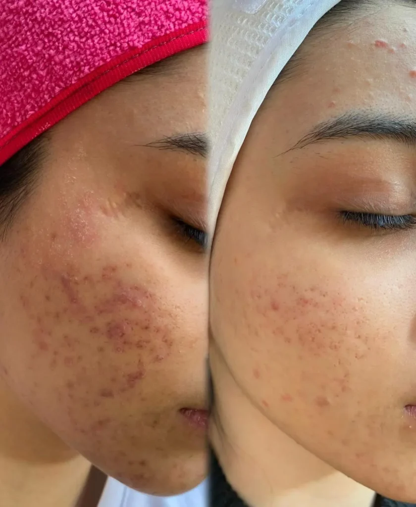 Acne Buster facial treatment results at Medcura Clinic Harrow