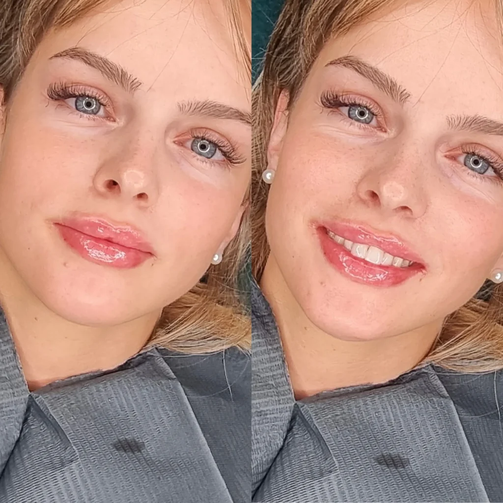 Natural-looking lip filler results at Medcura aesthetics clinic