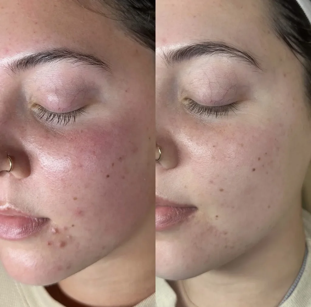 Acne and pore-clearing facial treatment results at Medcura Stanmore