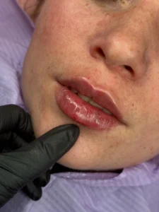 Lip Filler in Greenford