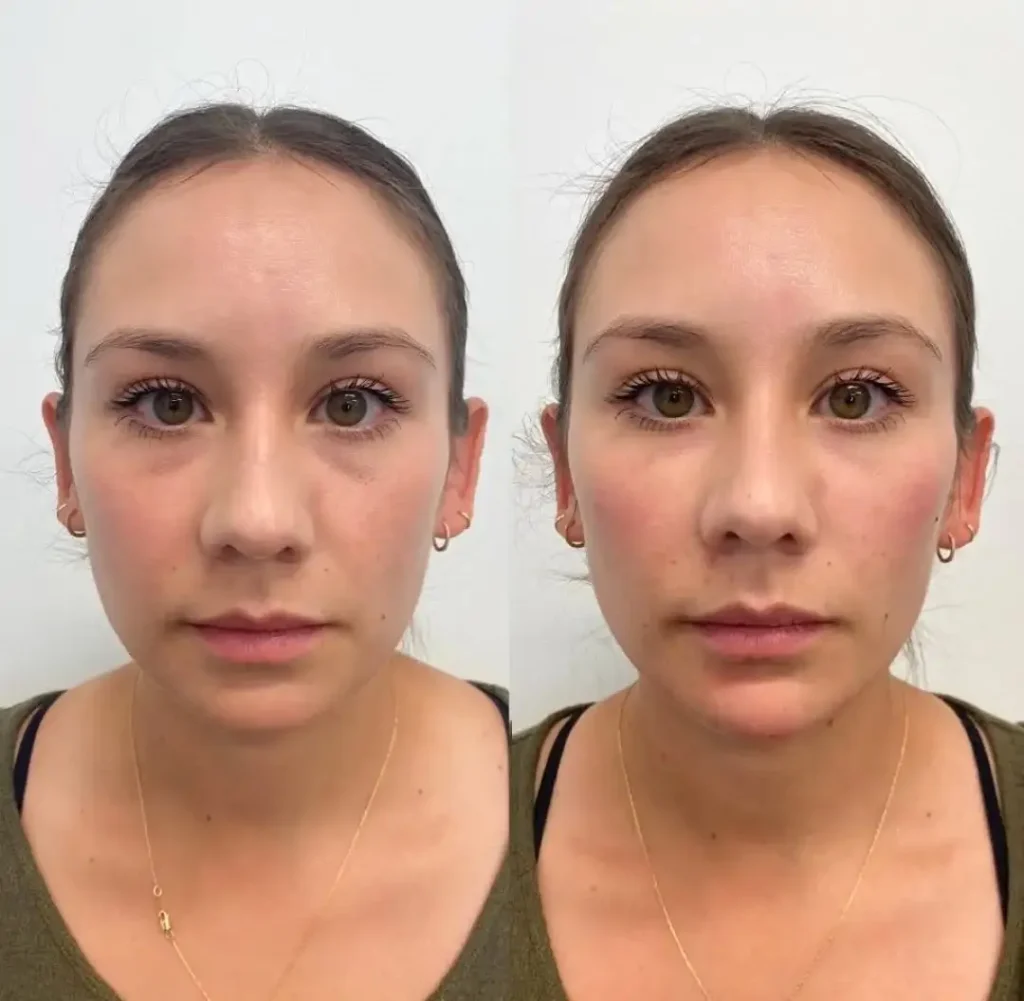 Under-eye, cheek and chin filler treatment results at Medcura Harrow