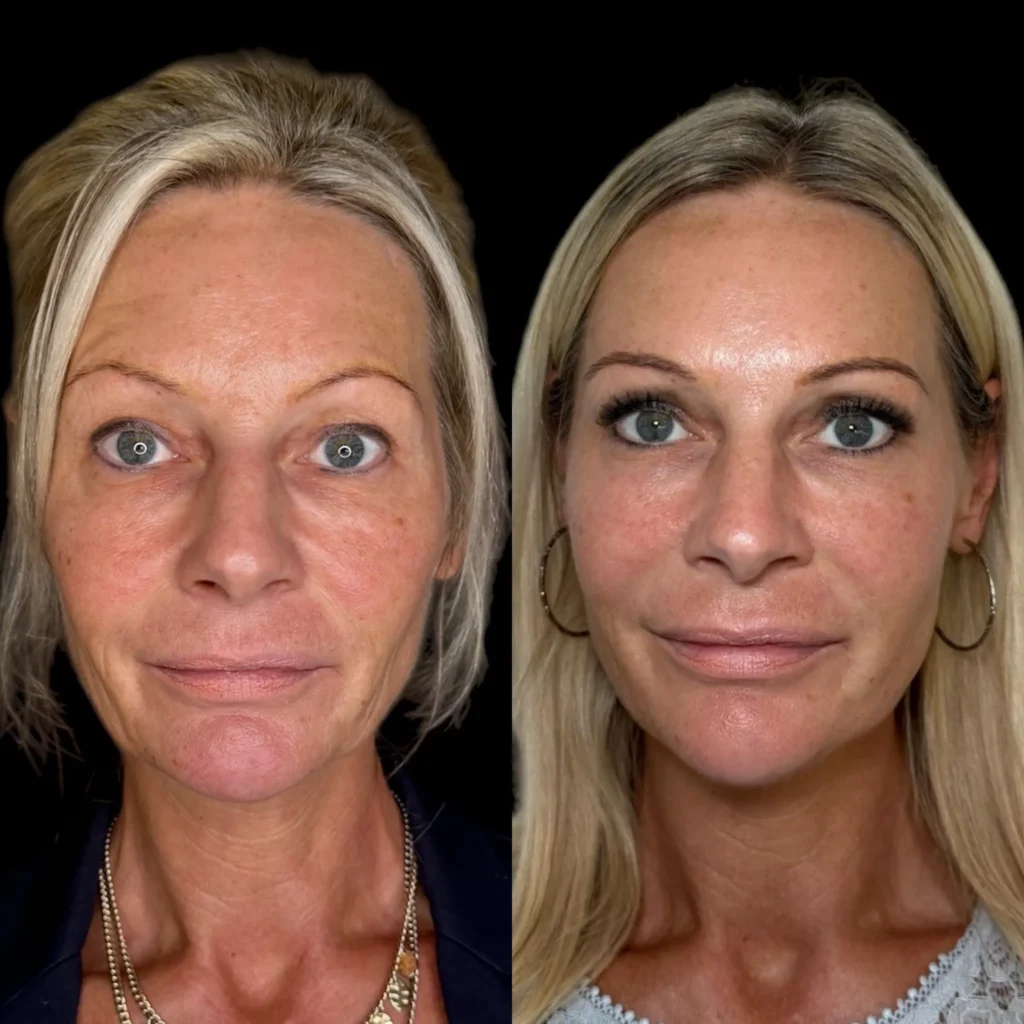 Ultimate Liquid Face Lift for skin tightening at Medcura Harrow