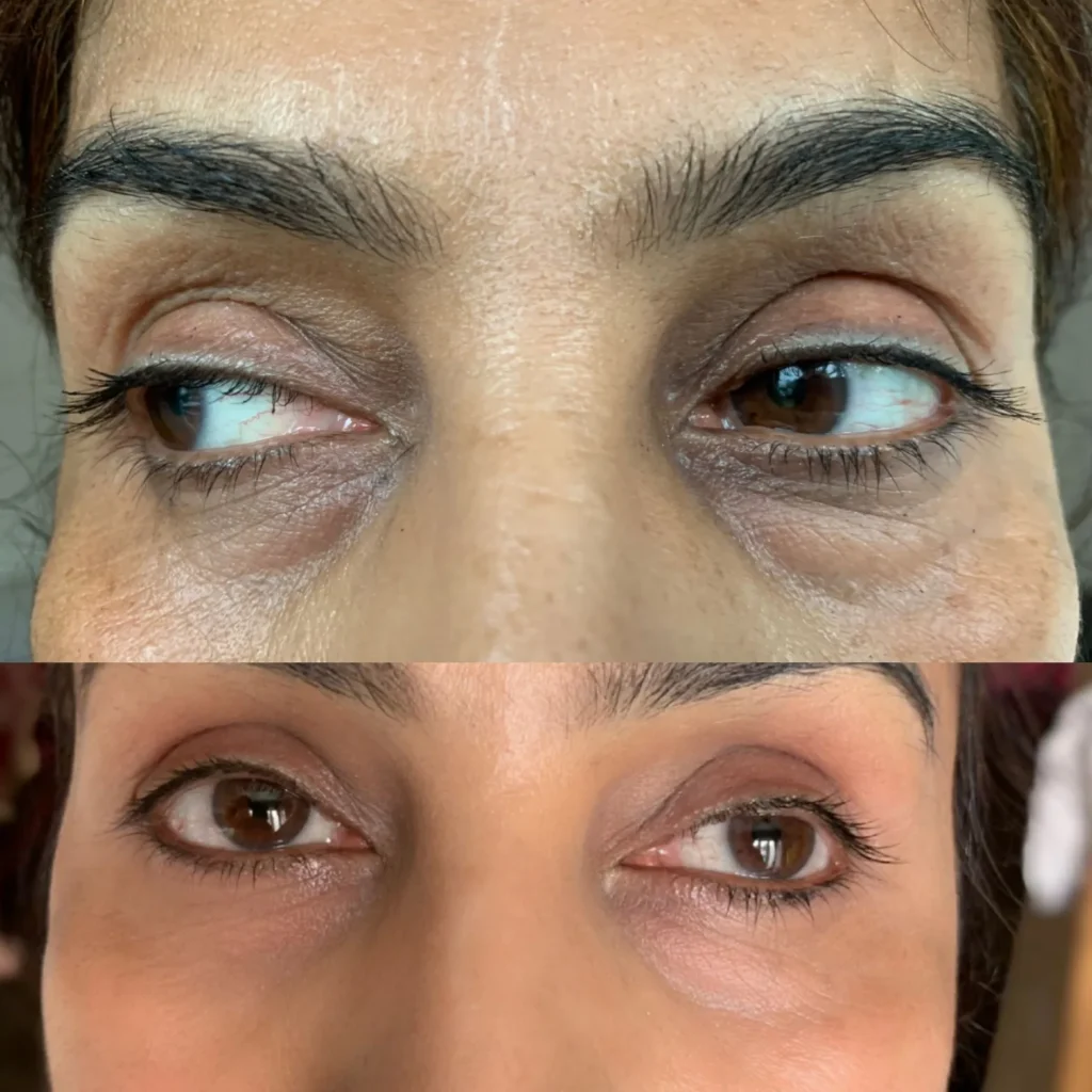 Microneedling with polynucleotides for skin renewal at Medcura Clinic Harrow