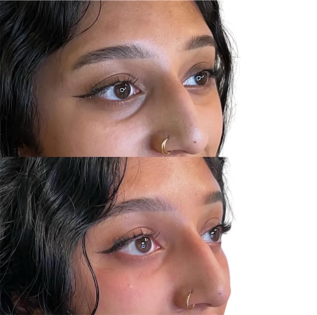 Before and after polynucleotide skin rejuvenation treatment at Medcura Harrow