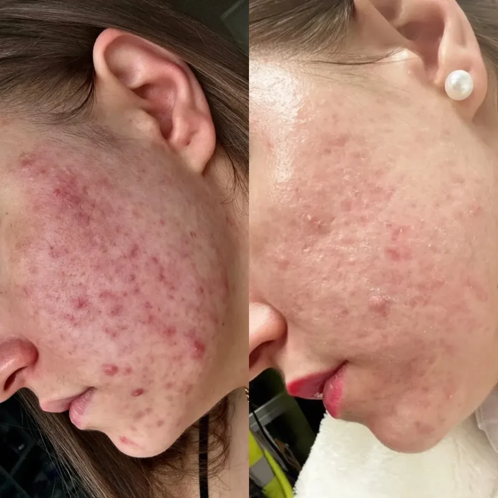 Before and after acne clearing programme at Medcura Stanmore