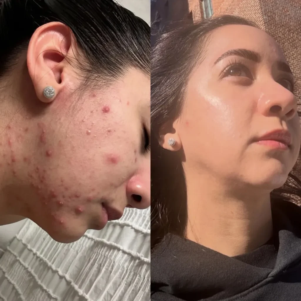 Acne clearing programme results at Medcura Clinic Harrow