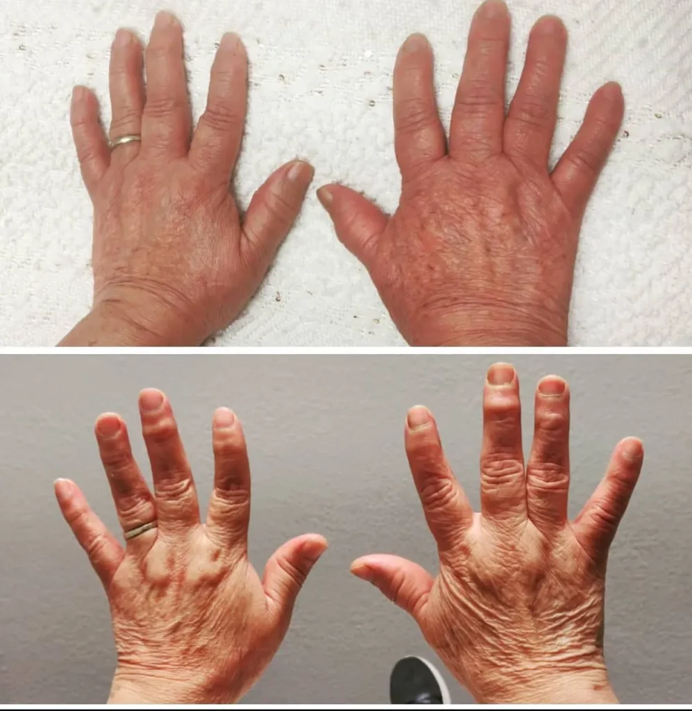 Spider Vein Removal in Stanmore