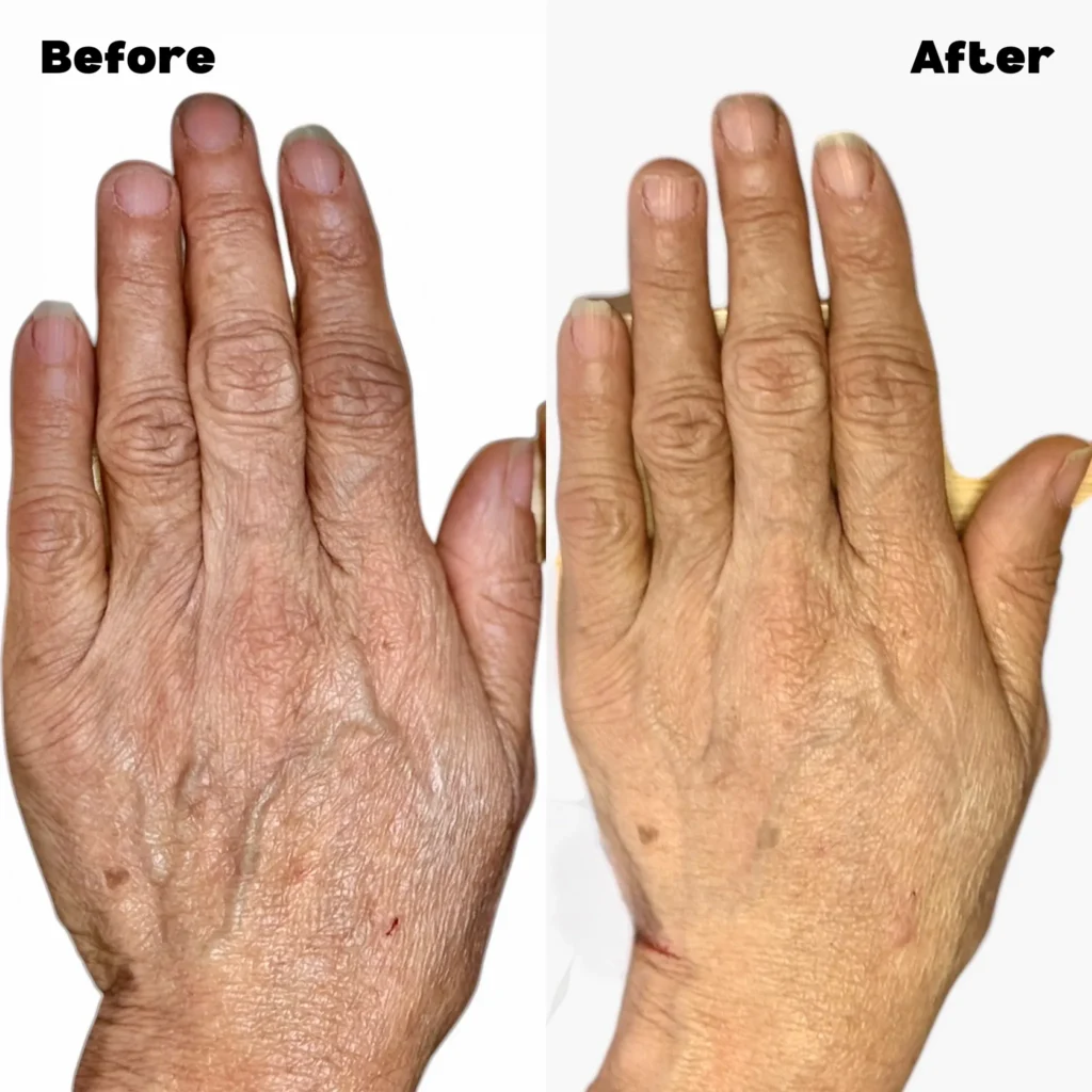 Spider Vein Removal in Stanmore