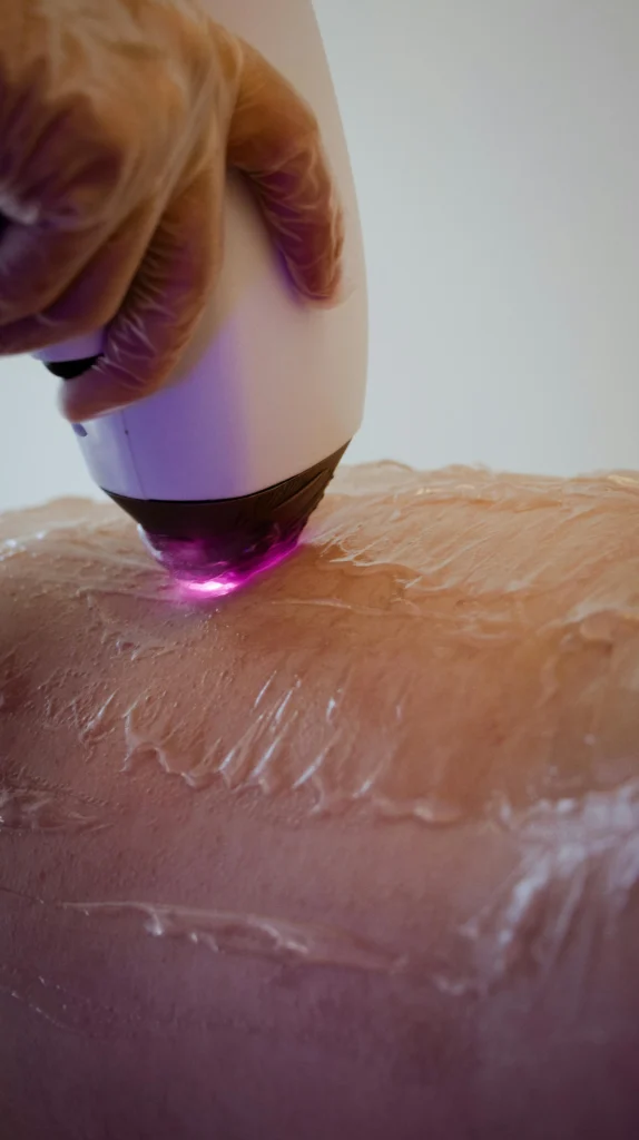 IPL Treatment in harrow, IPL TREATMENT