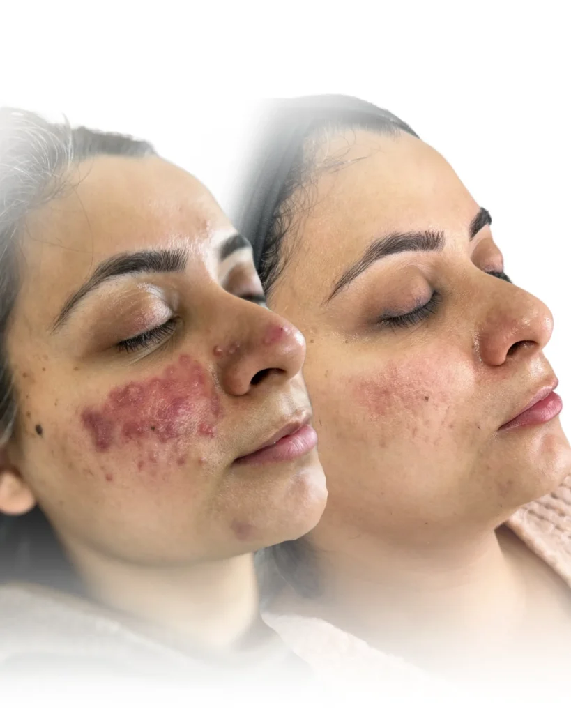 Acne Treatments in Harrow
