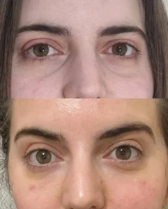 CO2 Laser Resurfacing for Eyes in Ealing