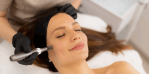 Best Microneedling in Stanmore