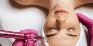 microneedling in pinner
