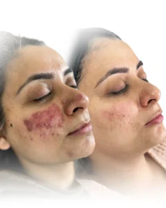Acne Treatment in Harrow