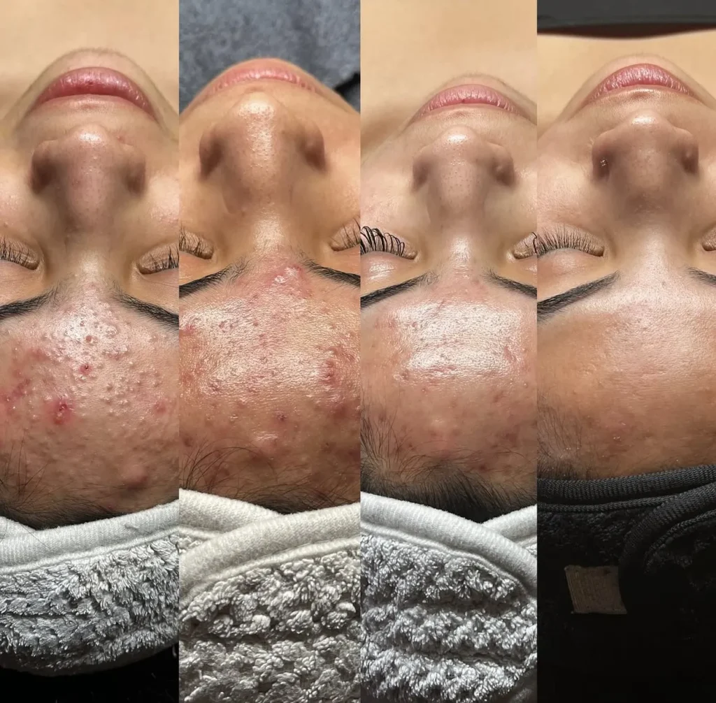 Acne Scar Treatment London