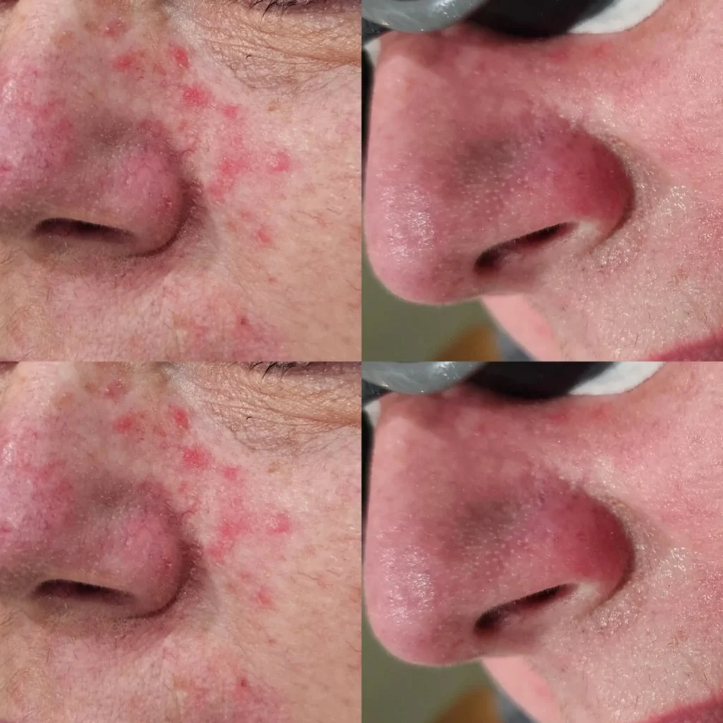 Acne Treatment in Harrow on the Hill