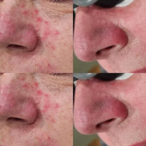 Acne Treatment in Harrow on the Hill