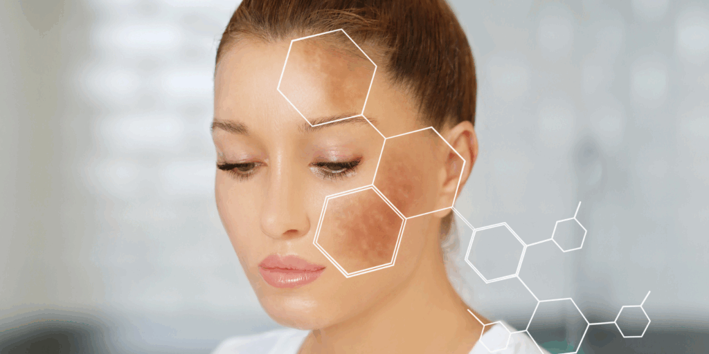 freckle facial treatments in Harrow