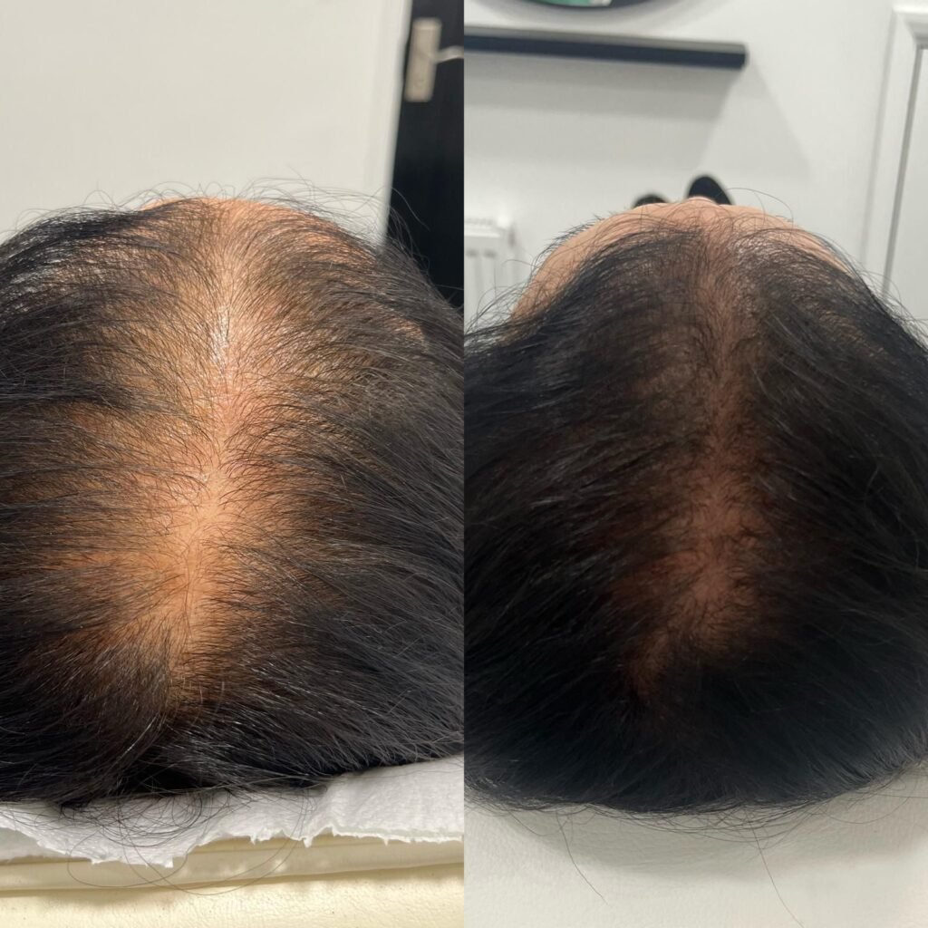 PRP Treatment in Edgware