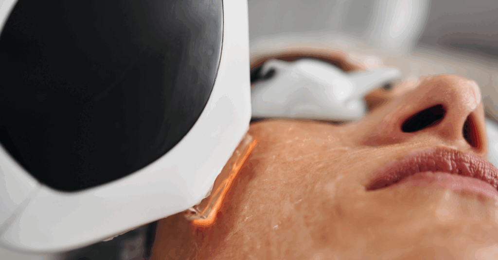 Co2 Laser Resurfacing Treatment in Southall