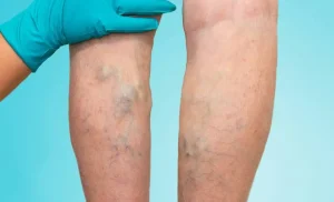 Spider Vein Removal in Stanmore