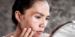 Post-Inflammatory Hyperpigmentation