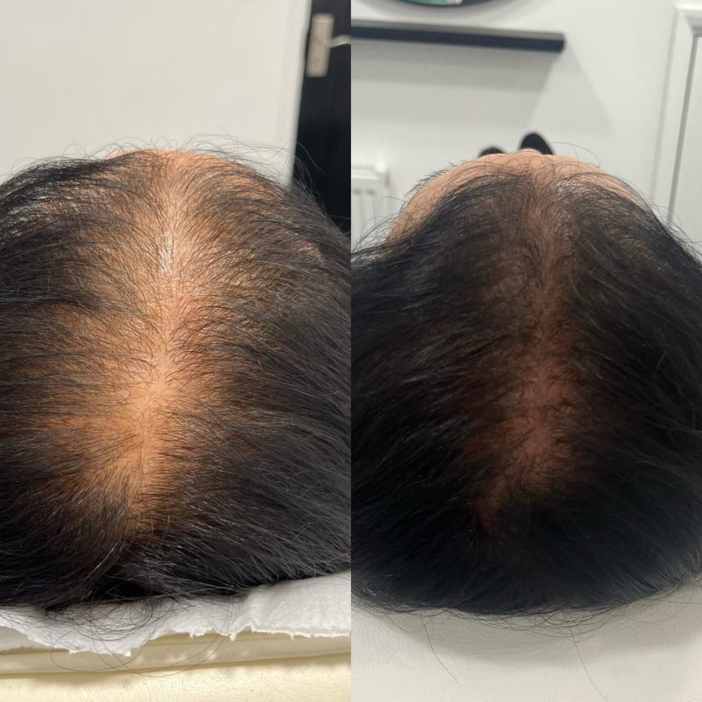 Regenerative Treatments in Ruislip
